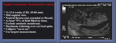 ultrasound fetal nuchal thickness measurement|normal nuchal translucent measurement.